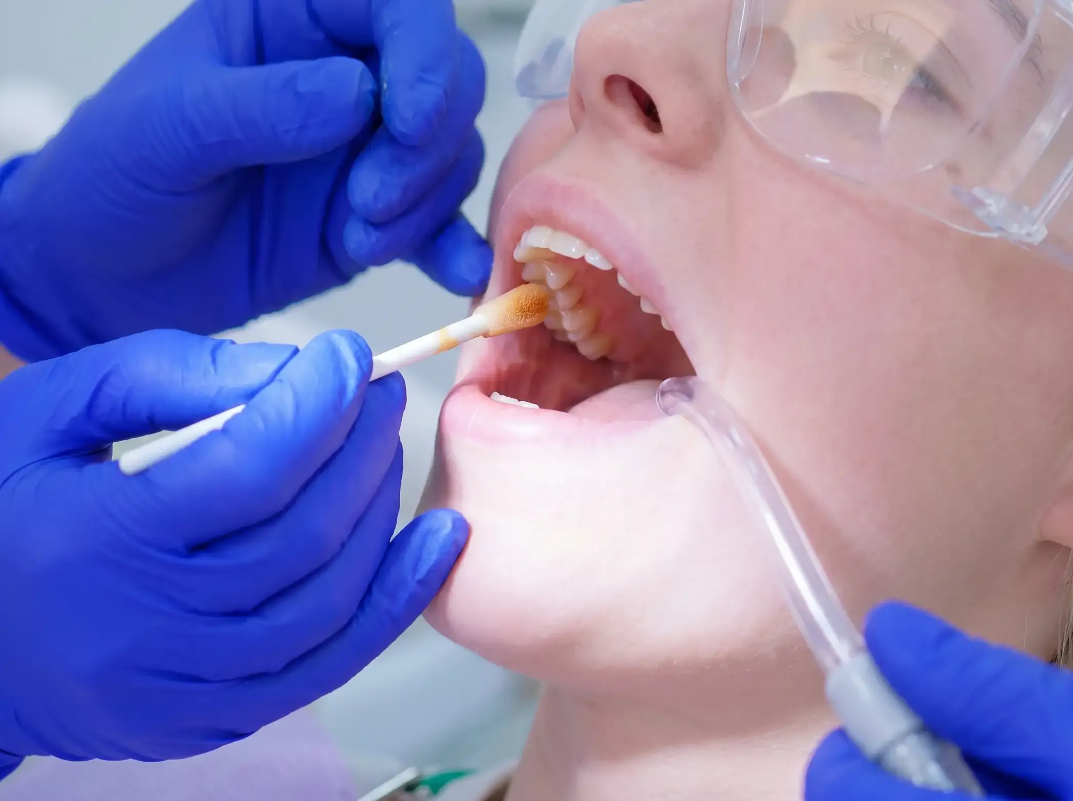Prevención de Caries