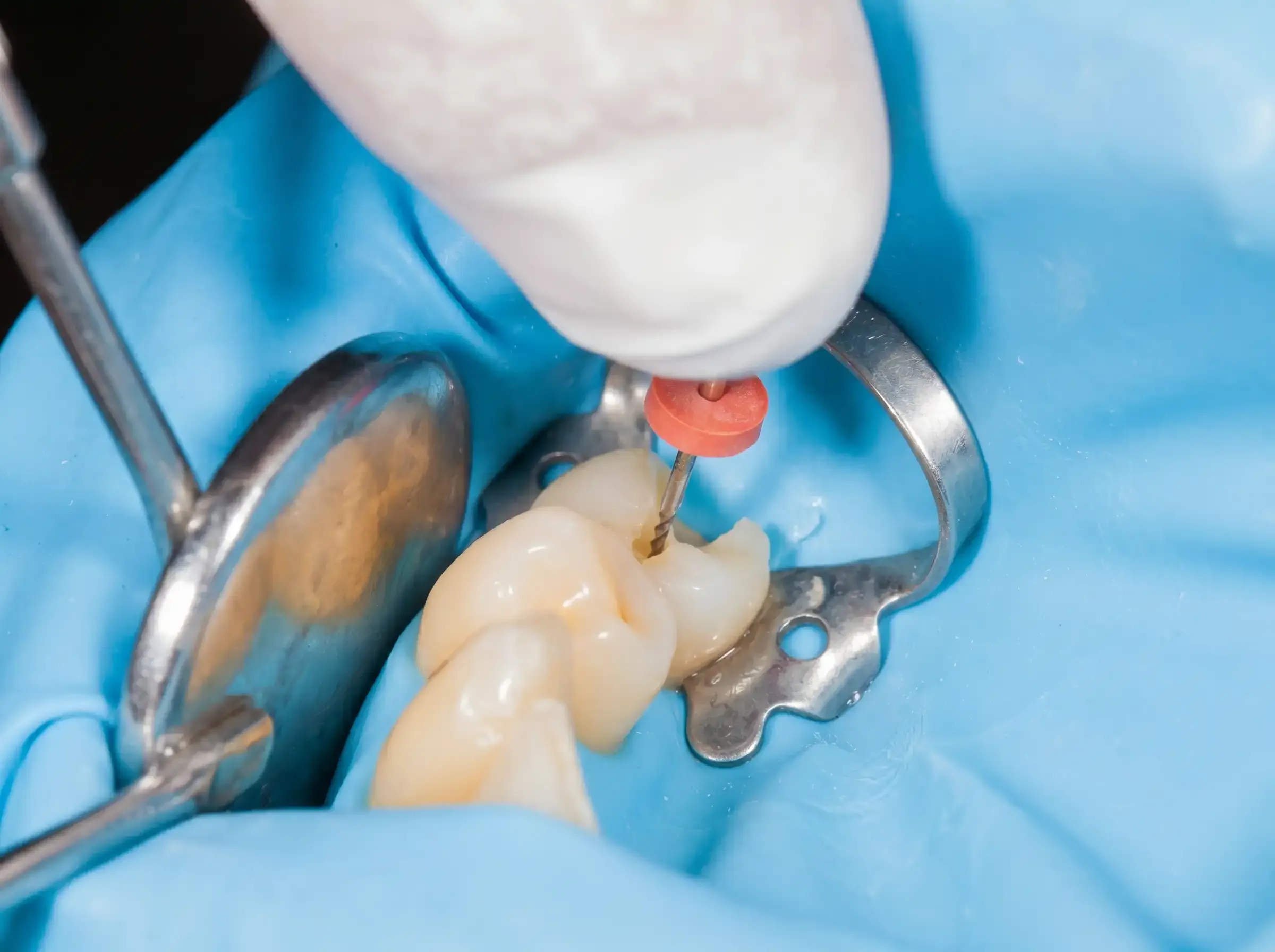 Endodoncia